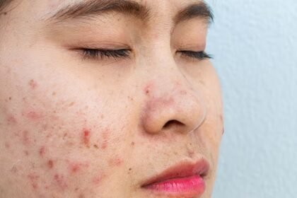 2 Skin Conditions a Dermatologist Treats